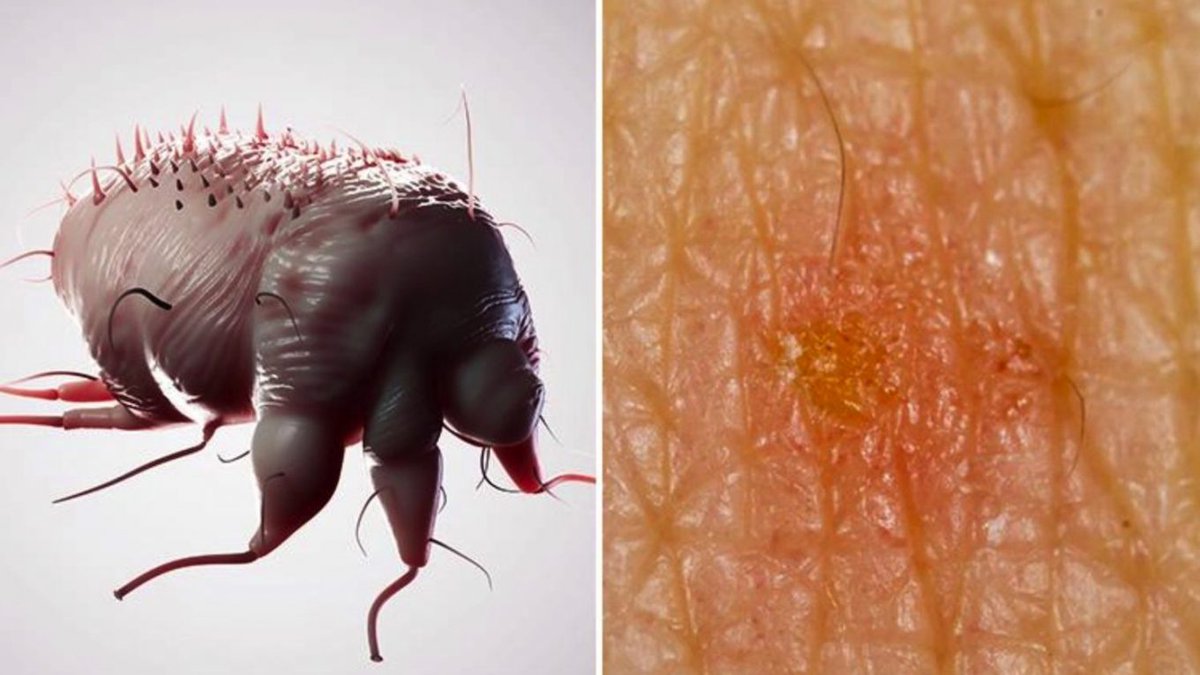 CovexitBlog's tweet image. Could Scabies Save you from COVID-19?

There is brand new research out of France, and the results are just astounding. The research is by Bernigaud et al. and is published in the Annales de Dermatologie et.....

Read more at covexit.com/could-scabies-…

#COVIDー19 
#coronavirus