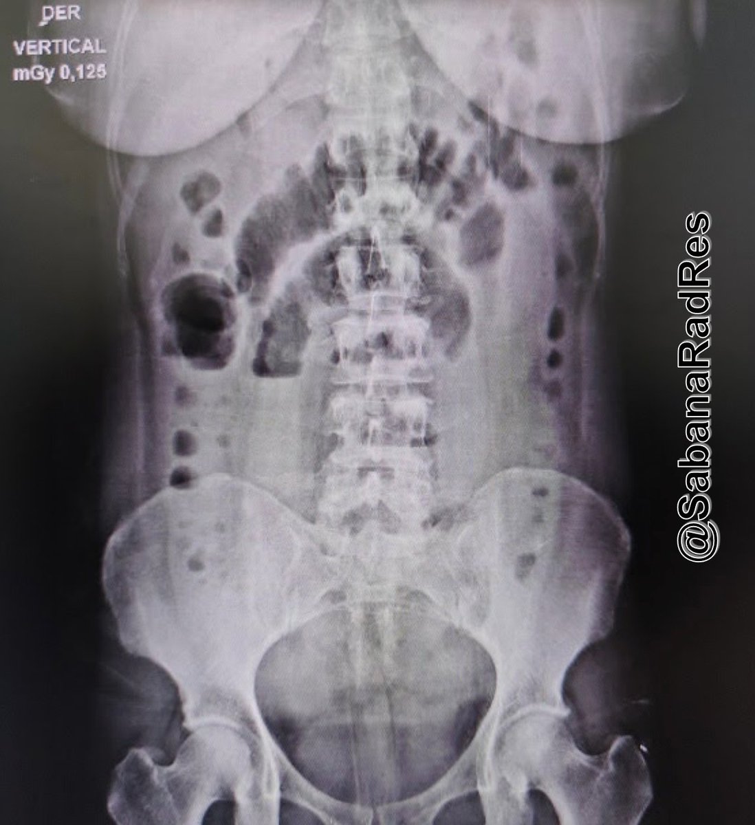 SabanaRadRes's tweet photo. #RadCase 🖥️ #Radiology #FOAMrad #radiologia #FOAMed #medicina https://t.co/U0KmCn8qrk