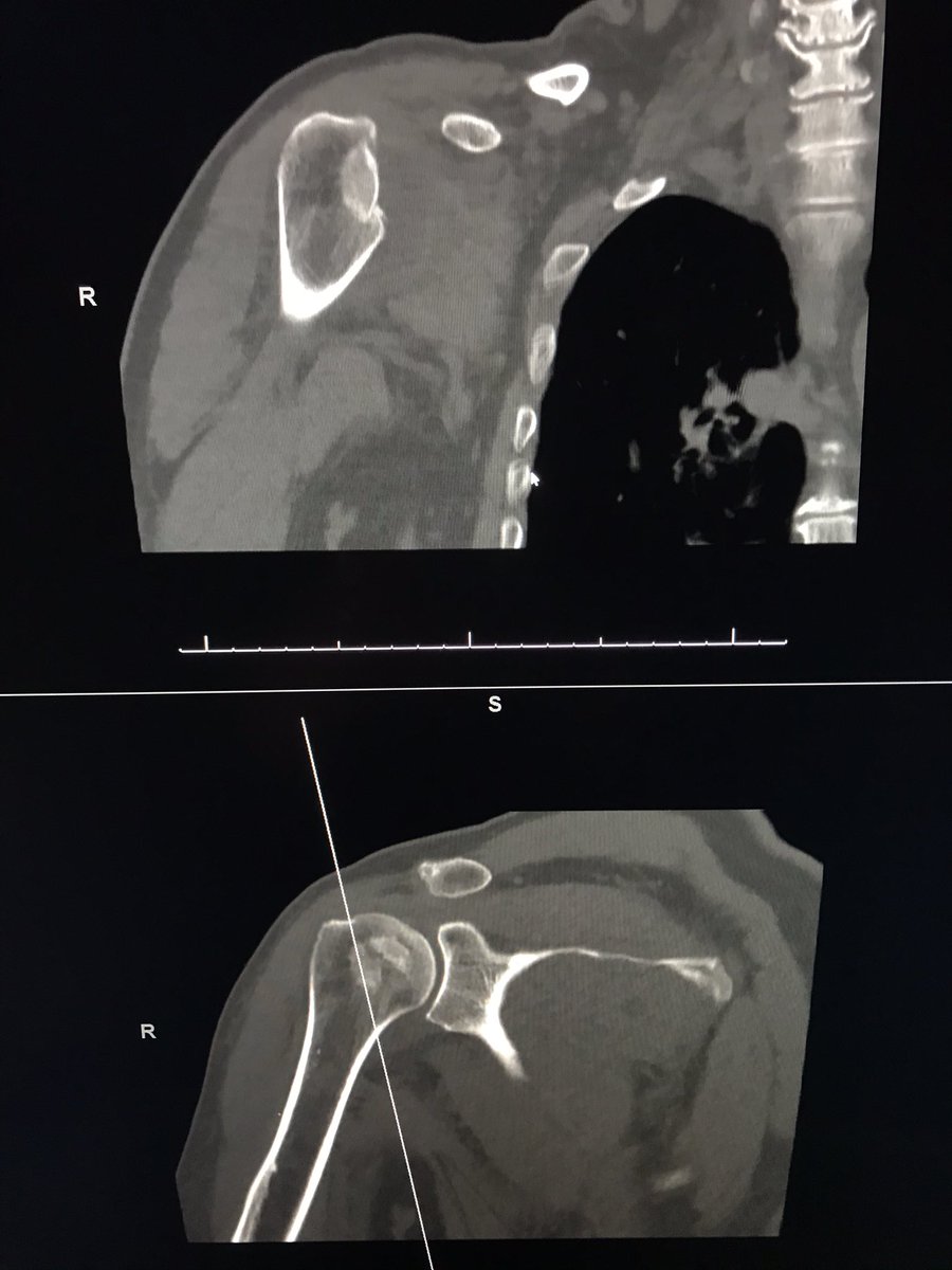 the_saxinator's tweet photo. Been a while since I’ve seen one of these. Can you make the diagnosis on just the X-ray? #MSKRad https://t.co/SX69f775Xw