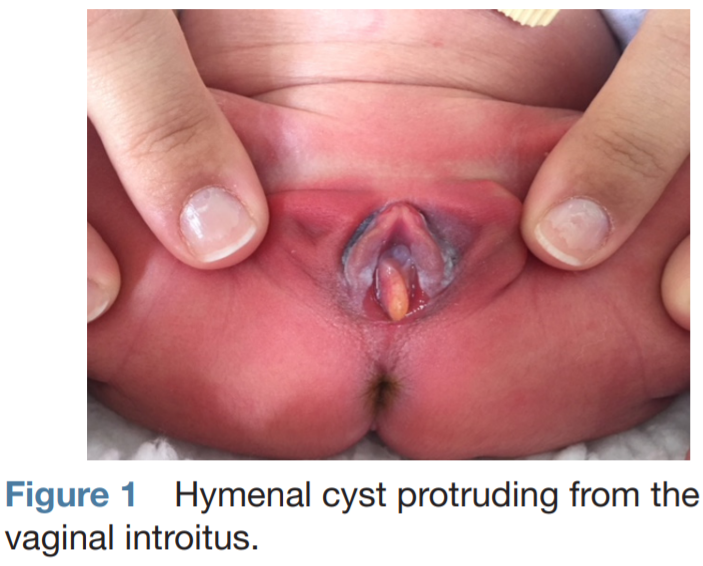 Vaginal cyst removal medical course