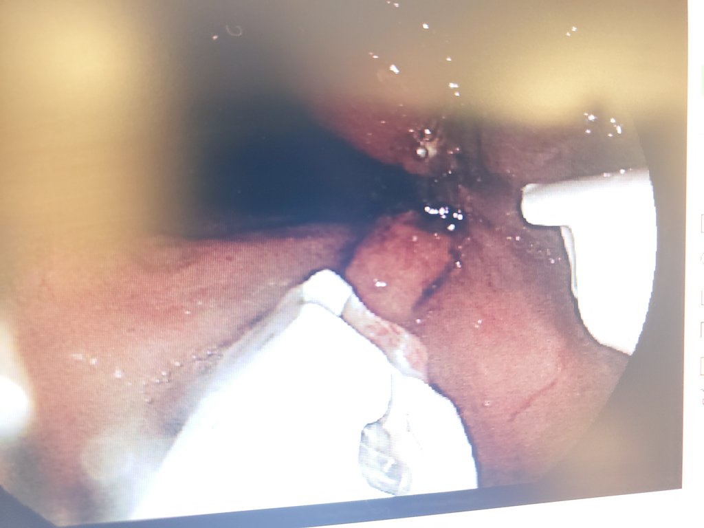 GIDrDon's tweet photo. Rectal polyp TVA w/ HGD on initial biopsies. Removed en-bloc by #ESD closed with #apollooverstitch single channel system. A little tricky to use but good enough for government work ๐ Patient discharged same day. #thisiswhatwedo #interventionalgi #GITwitter #MedTwitter https://t.co/qIzAfwsgG7