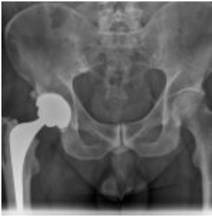 jbjs's tweet photo. JBJS Image Quiz - What's Your Diagnosis?
A 52-year-old fit and well man with a body mass index of 26 kg/m2 and no medical history underwent right total hip replacement...
https://t.co/ovXxfYSEUe https://t.co/QScPH05M5J