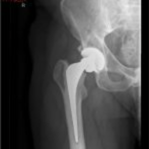 jbjs's tweet photo. JBJS Image Quiz - What's Your Diagnosis?
A 52-year-old fit and well man with a body mass index of 26 kg/m2 and no medical history underwent right total hip replacement...
https://t.co/ovXxfYSEUe https://t.co/QScPH05M5J