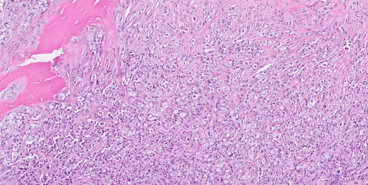 1/  #PathTwitter what is your understating on this skeletal metastasis in an elderly female?  #pathology  @smlungpathguy  @natasharekhtman 