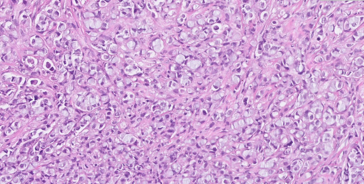 1/  #PathTwitter what is your understating on this skeletal metastasis in an elderly female?  #pathology  @smlungpathguy  @natasharekhtman 