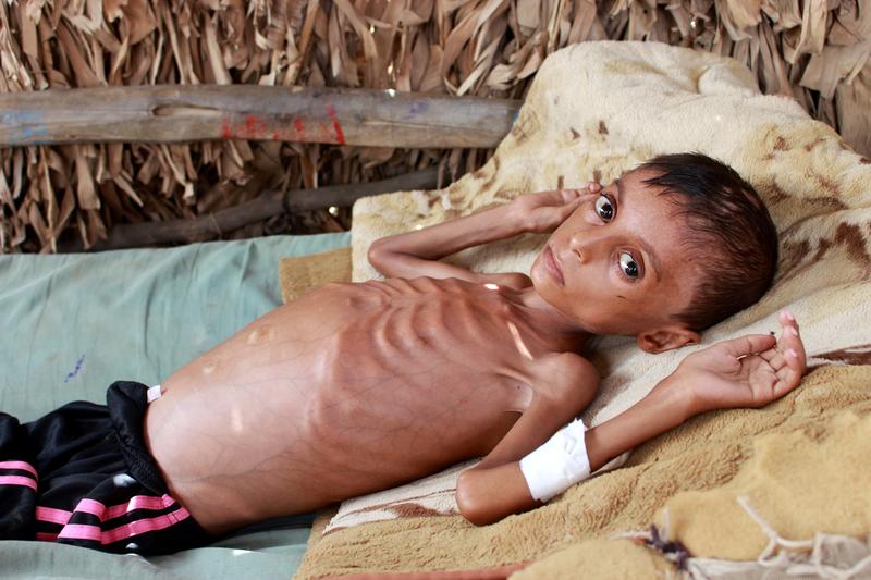 Yemeni boy fights malnutrition as hunger stalks nation's children https://t.co/G7xaFGmazh https://t.co/8v8TVb10pb
