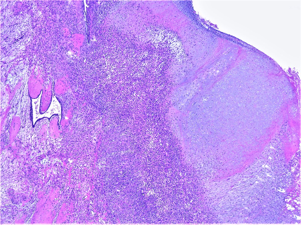 Patholwalker's tweet image. Malignant phyllodes tumor. Breast, masterctomy. #Pathologist #Pathology #Breastpath