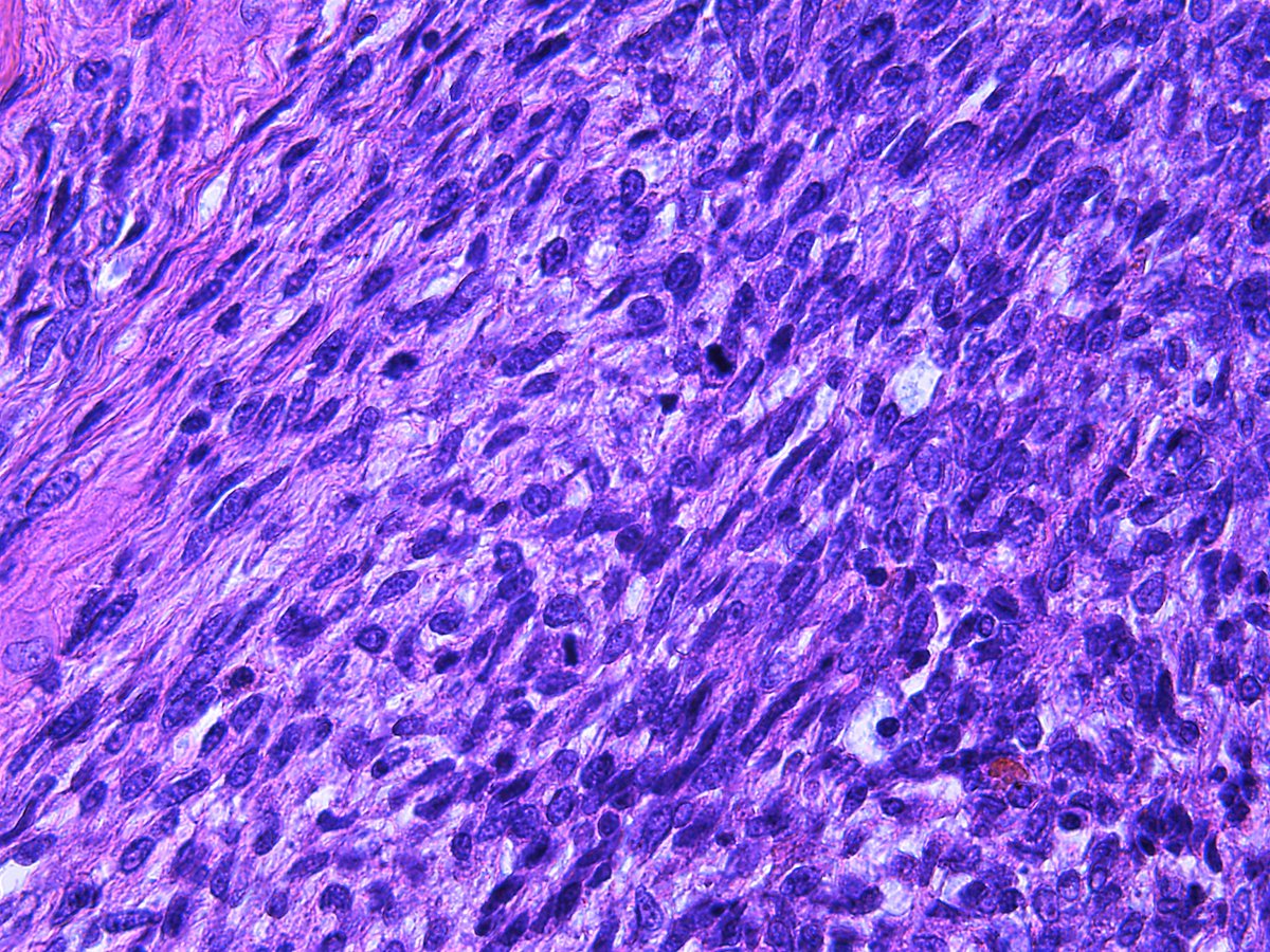 Patholwalker's tweet image. Malignant phyllodes tumor. Breast, masterctomy. #Pathologist #Pathology #Breastpath