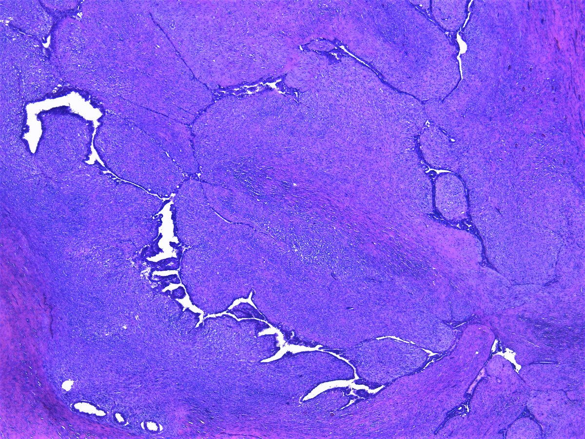 Patholwalker's tweet image. Malignant phyllodes tumor. Breast, masterctomy. #Pathologist #Pathology #Breastpath