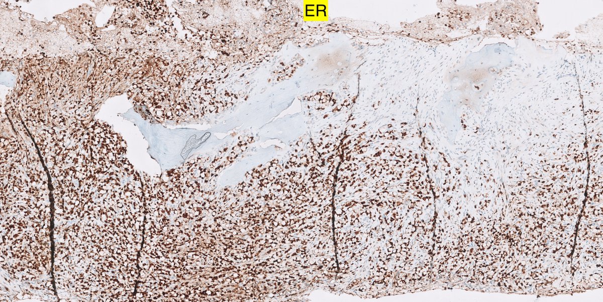 6/ Thanks everyone!!! Not easy too fool the Tweeples nowadays  ER and mammaglobin IHCs 