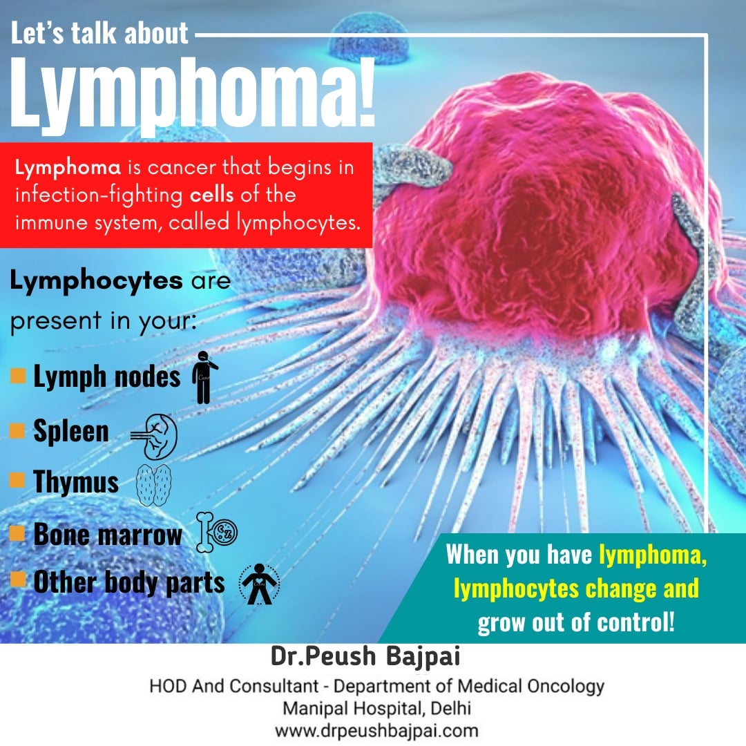 Lymphoma is among the most common causes of cancer in children and young adults aged 15–24 years!
Lymphoma is a cancer of the lymphatic system. 

Click here: drpeushbajpai.com

#oncology #Dwarka #Delhi #lymphoma #lymphnodes #healthcare #drpeushbajpai #health #india