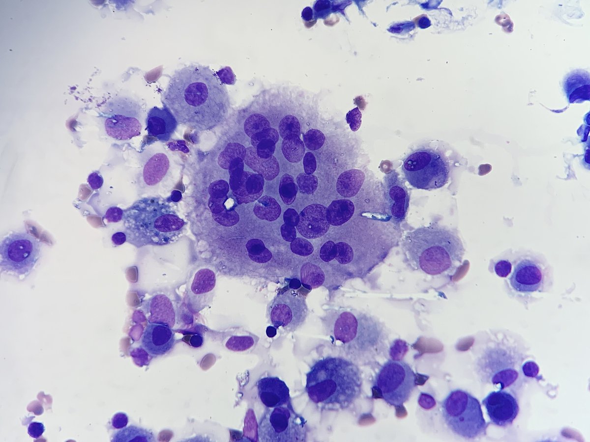 ShirazFidai's tweet photo. Male in 20s.
Diffuse peribronchial thickening with upper lung lobe infiltrates & hilar adenopathy.
Non-necrotizing granulomas in BAL.
Simple. Classic. Beautiful.
And a giant cell.
#cytology #cytopath #PathTwitter #DiffQuik https://t.co/foATnGOrf4