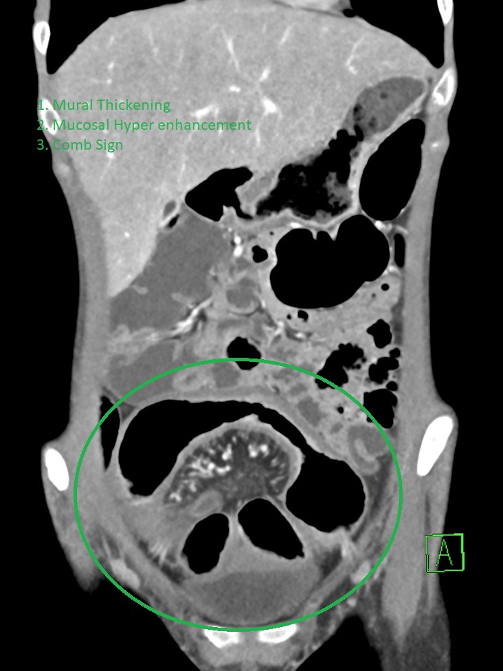 NshRadiology's tweet photo. CT #Enterography and MR Enterography are great #Radiological tools to diagnose and monitor patients with #crohns disease. Our radiologists are more than capable of performing and reading these studies https://t.co/2kmz2dWZUa