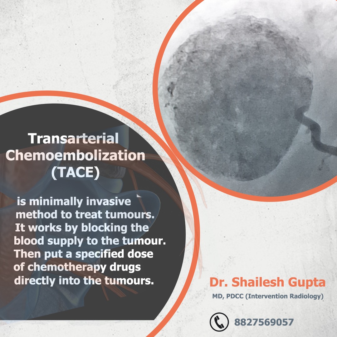 TACE involves surgically implanting a catheter into the major artery (hepatic) that supplies blood to the liver. 
#drshaileshgupta #Interventionalradiology #interventionalradiology #interventionalradiologist #tumour #liverhealth #liverhealing #livertransplant 
#livercancer #cured