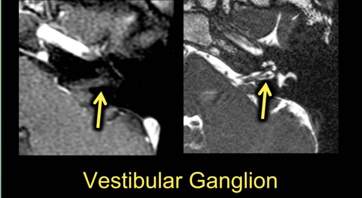 Did you know? Vestibular ganglion/Scarpa's ganglion can mimic a tiny schwannoma. Thanks @rhwiggins #RSNA20 #hnrad. Now can we stop following these by imaging ( I think not !) Another mimic is venous plexus in the IAC ajnr.org/content/early/…