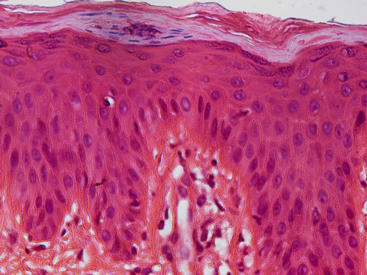 alaboudkhalid's tweet photo. ⁦@IHeartHisto⁩ ⁦@iheartpath⁩ ⁦@IHeartPathology⁩ ⁦@ilovepathology⁩ ⁦@pembeoltulu⁩ ⁦@ChristineJKoMD⁩ ⁦@JMGardnerMD⁩ ⁦@DrGeeONE⁩ ; any body wish to link these images and win 👑?#dermatology #dermpath #eponym https://t.co/BESNahl16R