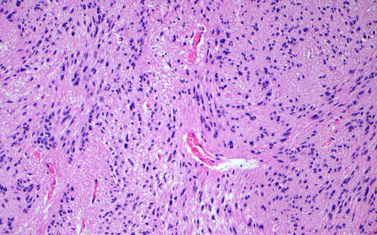 bitar_mireille's tweet photo. Subventricular mass (coronal brain section and histology images ), diagnosis ? #brainautopsy #brainmass #neuropathology #pathtwitter #neuroanatomy https://t.co/WvsbJRStAX