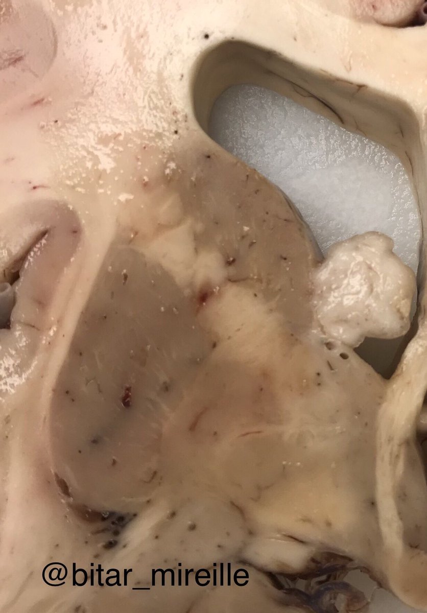 bitar_mireille's tweet photo. Subventricular mass (coronal brain section and histology images ), diagnosis ? #brainautopsy #brainmass #neuropathology #pathtwitter #neuroanatomy https://t.co/WvsbJRStAX