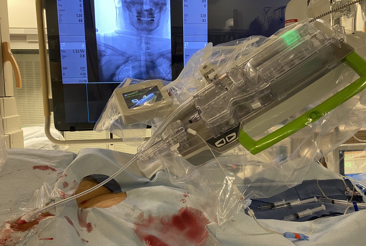 STateshimaMD's tweet photo. For robotic radial access using #Corindus #CorPath, snuffbox puncture works better ergonomically. #roboticintervention #roboticfirst https://t.co/A7JgJxOWdt