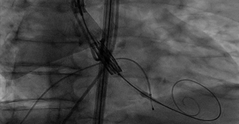 Au menu du JT de 13h de #GRCI le mag: tricuspid et mitral! 👉grci.fr/grci-le-mag