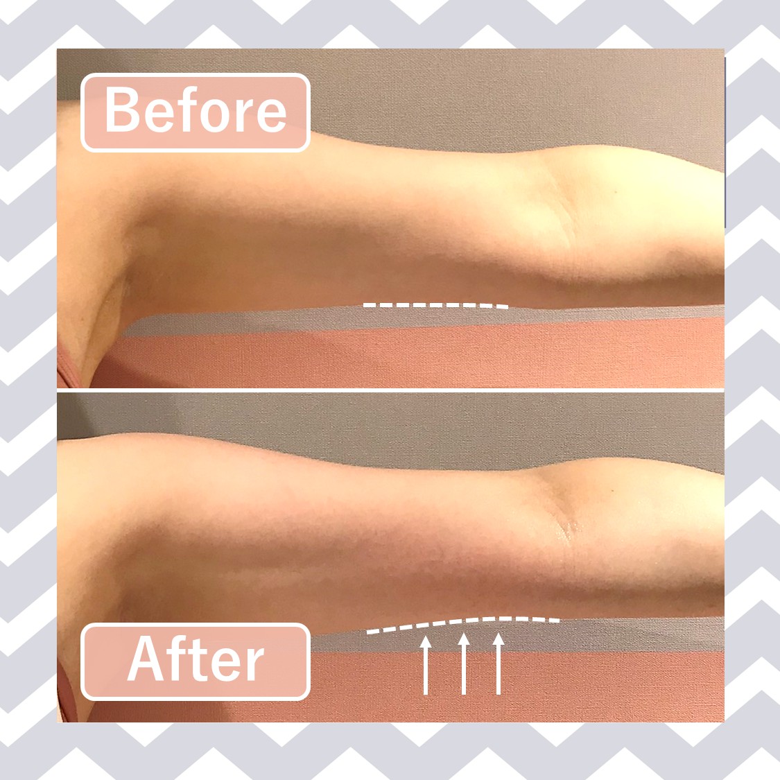 定額制セルフエステ Body Archi ボディアーキ 公式 今回は二の腕を15分施術してみました モノポーラで深部から温め マルチポーラでセルライトに Ems 吸引で筋肉にアプローチすることでたるみを引き締めます 脇の下は老廃物が溜まりやすいので