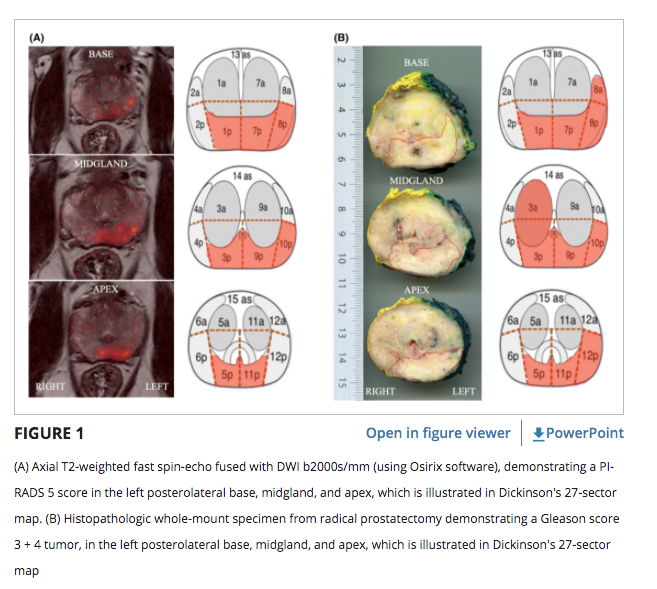 Our latest research findings on the diagnostic accuracy of multiparametric MRI for detection and localization of prostate cancer. A truly multisciplinary team !  bjui-journals.onlinelibrary.wiley.com/doi/full/10.10… #prostate #prostatecancer #urology #treatment