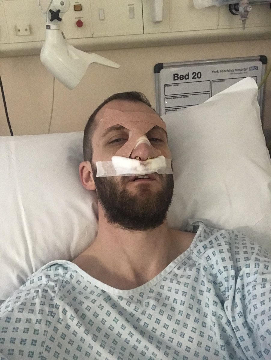 PFEW_HQ's tweet image. "Is it ok for me to be used as a punchbag?"

PC David Young's faith in courts left shattered after a man who fractured his nose &amp;amp; cheekbone walked free with a suspended sentence. #ProtectTheProtectors 

Full story ⬇️
buff.ly/3mItbGZ

@NYPFJBB @pritipatel @RobertBuckland