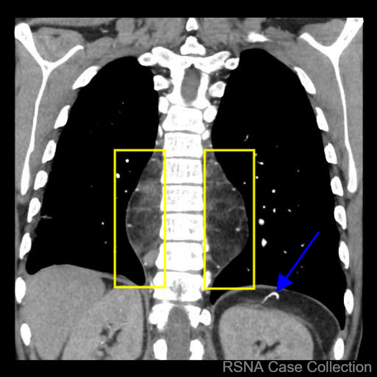 PGSharmaMD's tweet photo. You all “sleighed” this #RSNACC Case-of-the-Week: Extramedullary hematopoiesis! 

Check out this case and more at https://t.co/pSlrw1jBM0   

Thanks #ChestRad Deputy Editor Dr Walker @KURadiology and authors Drs @AnneBriss @DDxJamesHuynh @UofC_Radiology @CARadiologists https://t.co/iD0ZolcO1B