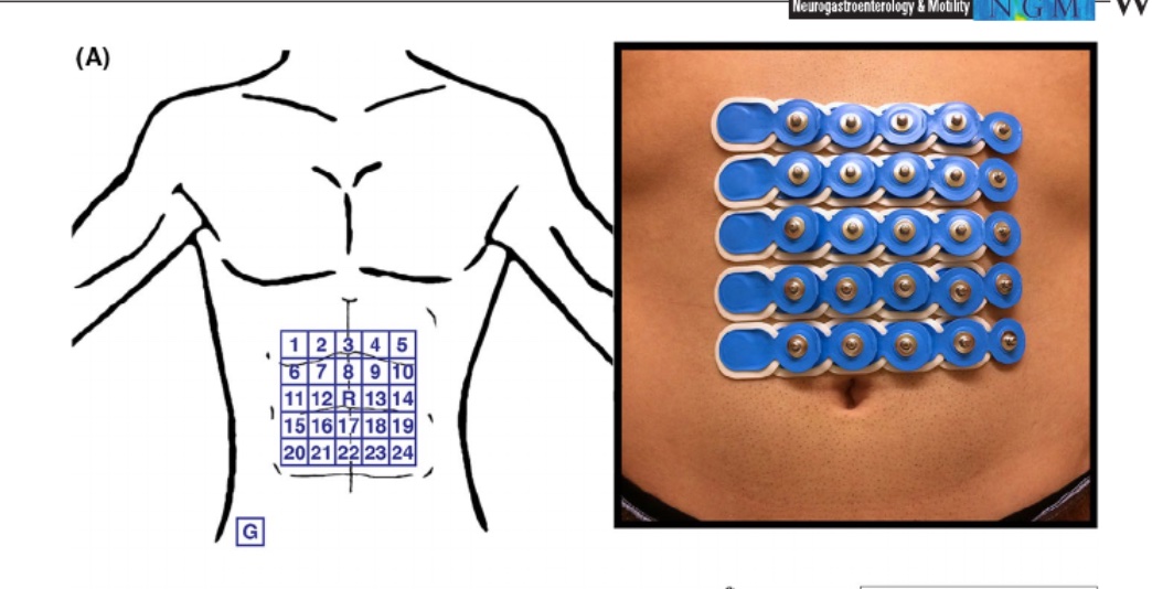 IBS_Maastricht's tweet image. This is really exciting. You actually have a number of techniques emerging that allows you to investigate gastric motility using body surface registration. Next-level EGG so to speak.

Check this excellent review in @NGMJournal 
#GITwitter #FGID

onlinelibrary.wiley.com/doi/10.1111/nm…