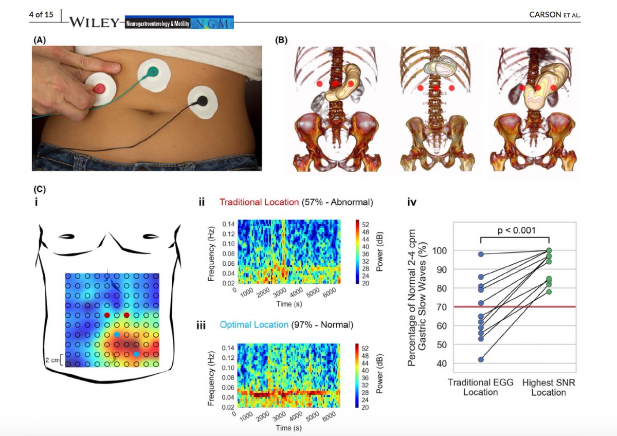 IBS_Maastricht's tweet image. This is really exciting. You actually have a number of techniques emerging that allows you to investigate gastric motility using body surface registration. Next-level EGG so to speak.

Check this excellent review in @NGMJournal 
#GITwitter #FGID

onlinelibrary.wiley.com/doi/10.1111/nm…