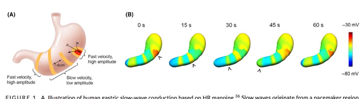 IBS_Maastricht's tweet image. This is really exciting. You actually have a number of techniques emerging that allows you to investigate gastric motility using body surface registration. Next-level EGG so to speak.

Check this excellent review in @NGMJournal 
#GITwitter #FGID

onlinelibrary.wiley.com/doi/10.1111/nm…