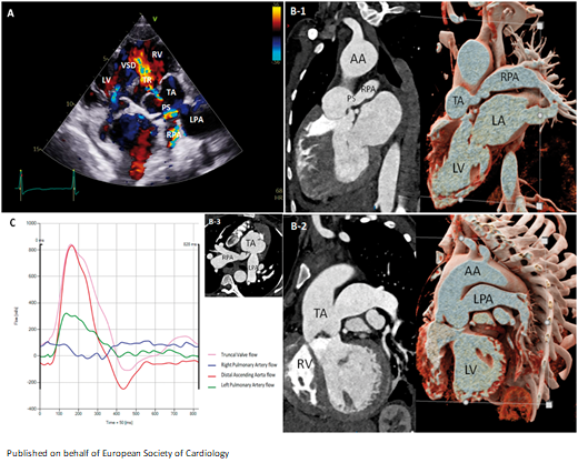ESC_Journals's tweet image. How #multimodalityimaging can help in the management of persistent truncus arteriosus bit.ly/33xQ1JW

@johncamm @cfcamm @FarhanaAra @DrPRao 

#EHJCaseReports #WhyCMR #echofirst #WhyCT