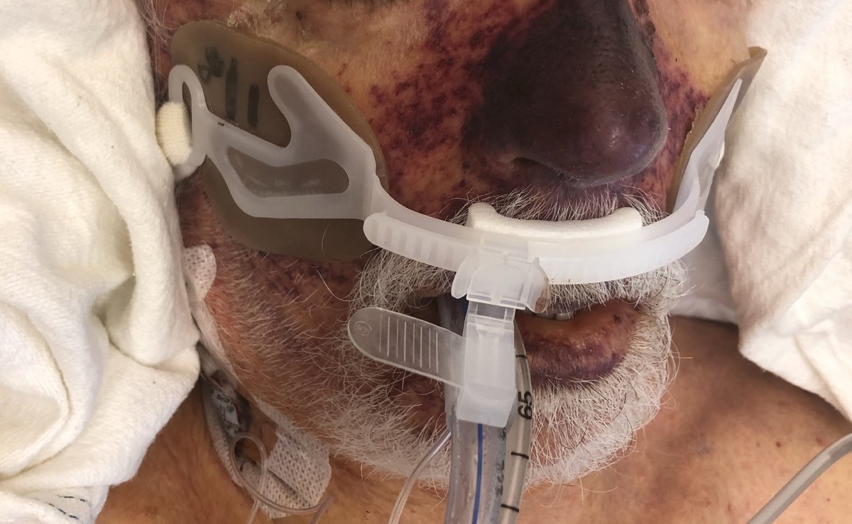 73M Hx TTP s/p splenectomy 10yr prior, otherwise healthy p/w worsening malaise, fevers, chills x24hr. PE wnl. Labs sig for mildly elevated lactate. Pt held for fluids & obs. In 6hrs, thrombocytopenic, coagulopathic, rising lactate with pH 7.1 & rapidly developing retiform rash.