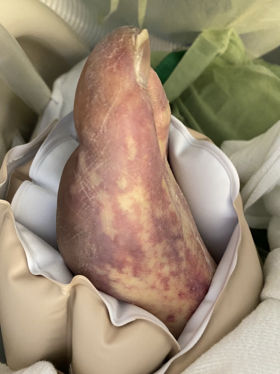 73M Hx TTP s/p splenectomy 10yr prior, otherwise healthy p/w worsening malaise, fevers, chills x24hr. PE wnl. Labs sig for mildly elevated lactate. Pt held for fluids & obs. In 6hrs, thrombocytopenic, coagulopathic, rising lactate with pH 7.1 & rapidly developing retiform rash.