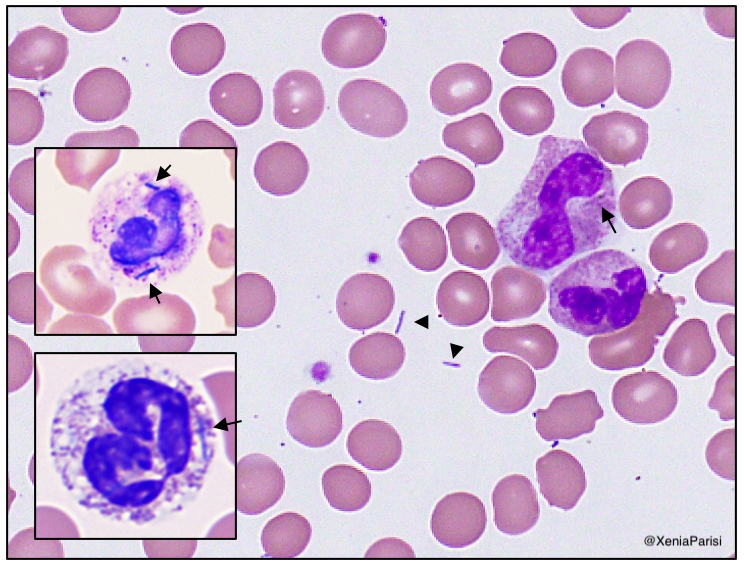 Purpura fulminans w/ infectious etiology favored. Blood Cx pending & pt started on broad-spectrum abx. ID requesting prelim on peripheral smear. Slides stained with Wright-Giemsa and (inlay) dilute Giemsa.Thoughts?