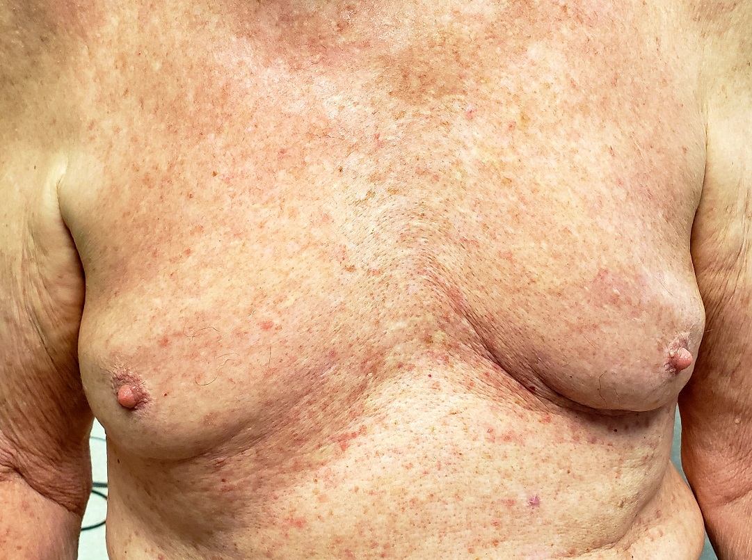 ClinRev's tweet photo. For months, the diagnosis of the rash on this 63-year-old man’s chest has not been clear. Will referral to dermatology reveal his condition? https://t.co/HgdRGhzo1W © 2020 Clinician Reviews/Frontline Medical Communications Inc https://t.co/ClJPjtD8vM