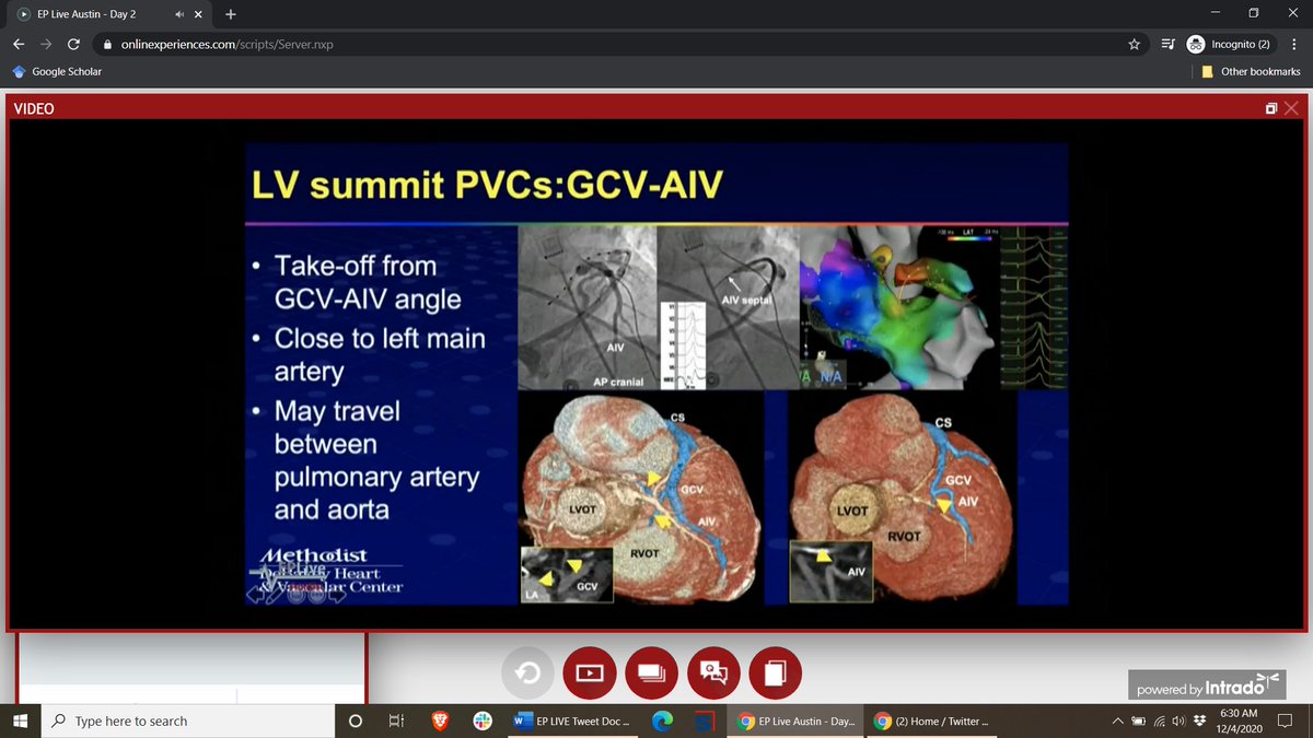 DebbeMcCall's tweet image. Why Do We Fail #VTach #Ablation? #EPLiveAustin