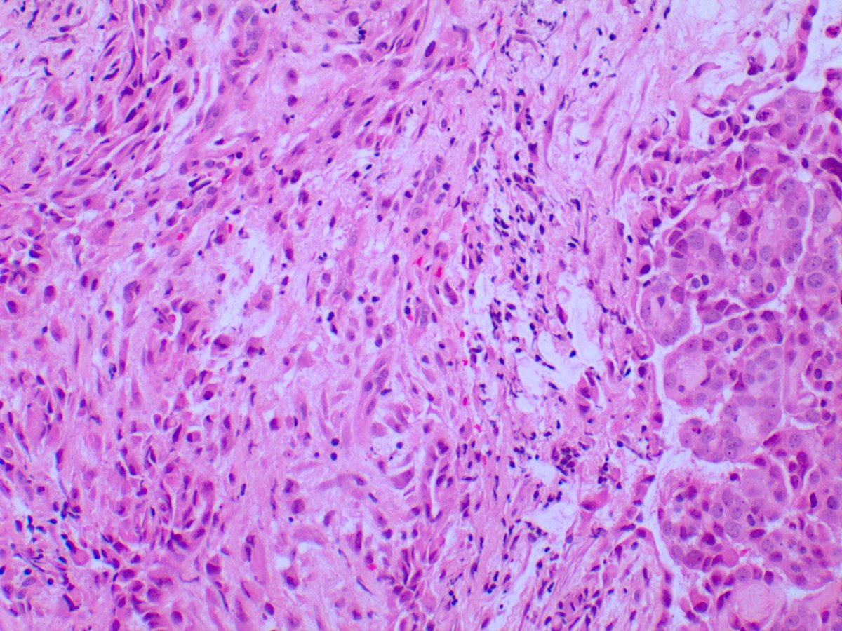 4. Getting back on track, our little lady in question two was married to this 74-year-old male, who also dabbled with asbestos sculptures in his garage. He too presents with a pleural rind.