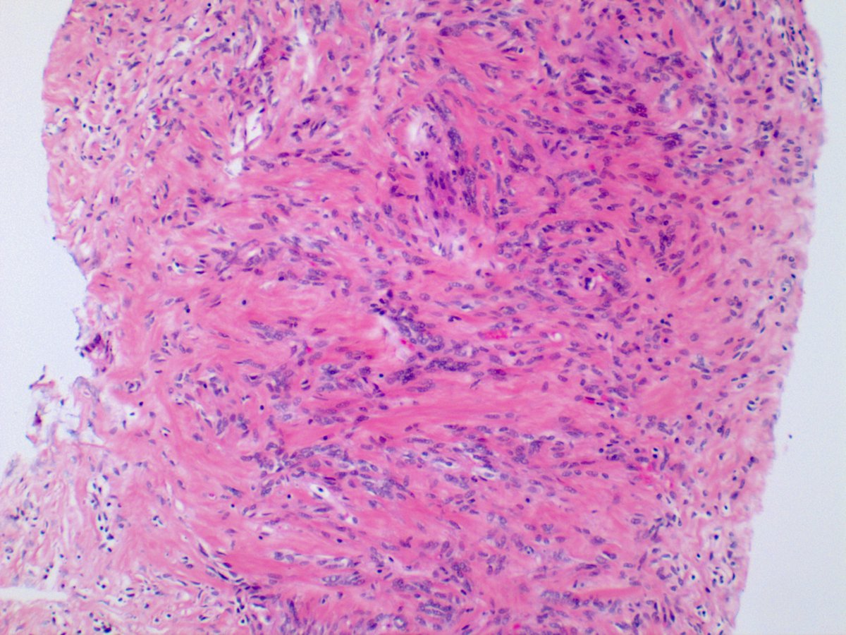 How about some pleural lesion  #pulmpath? 1/5  #tweetorial on thoracic  #spindlythings1. To get warmed up, let's start with a 43-year-old female, presenting with a peripheral lung mass