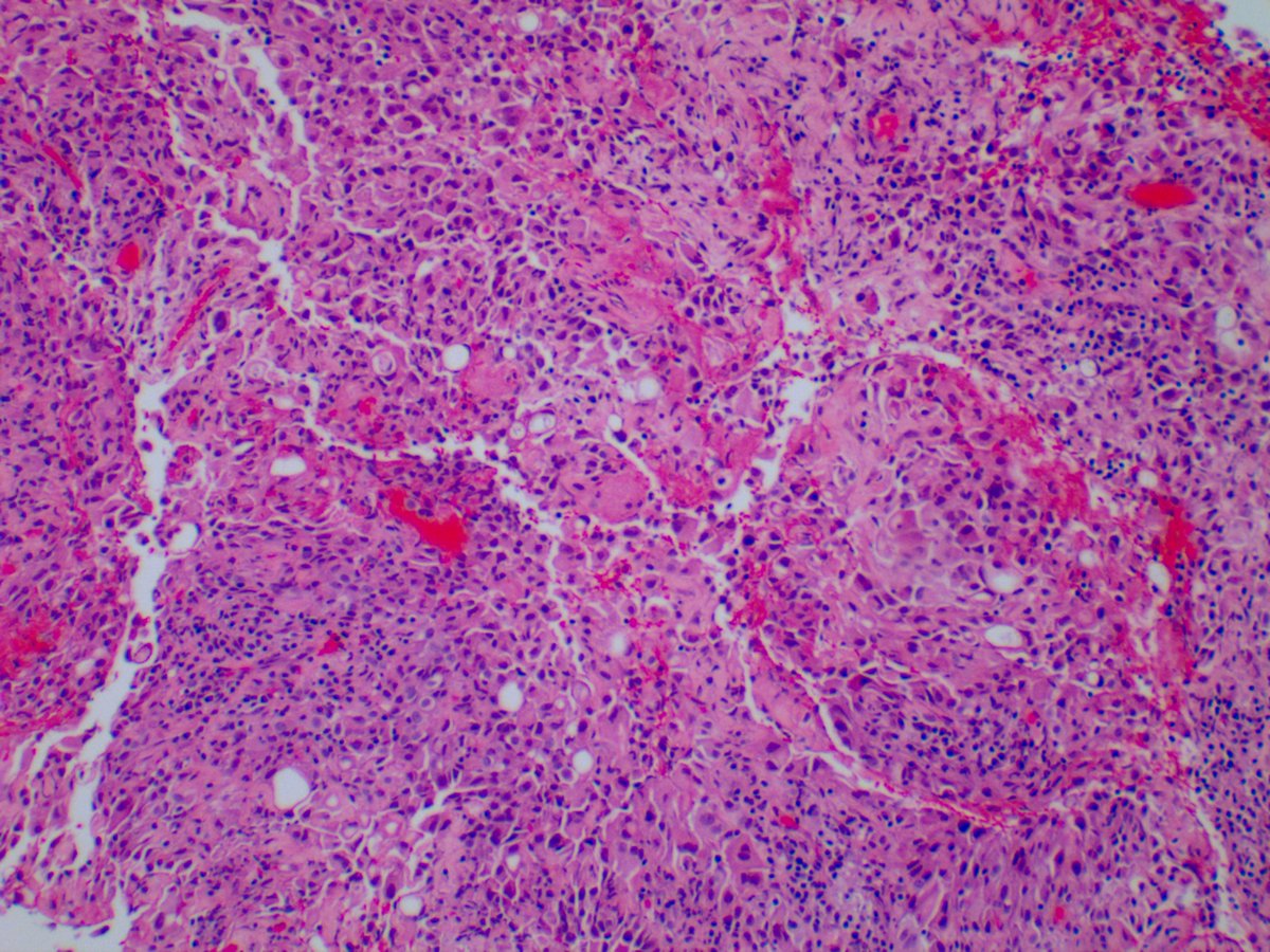 2. Next up is a 72-year-old lady with a pleural rind.