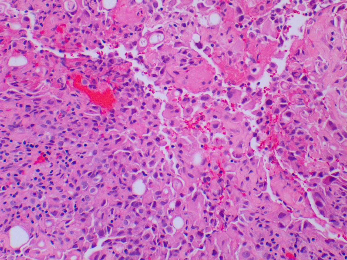 2. Next up is a 72-year-old lady with a pleural rind.