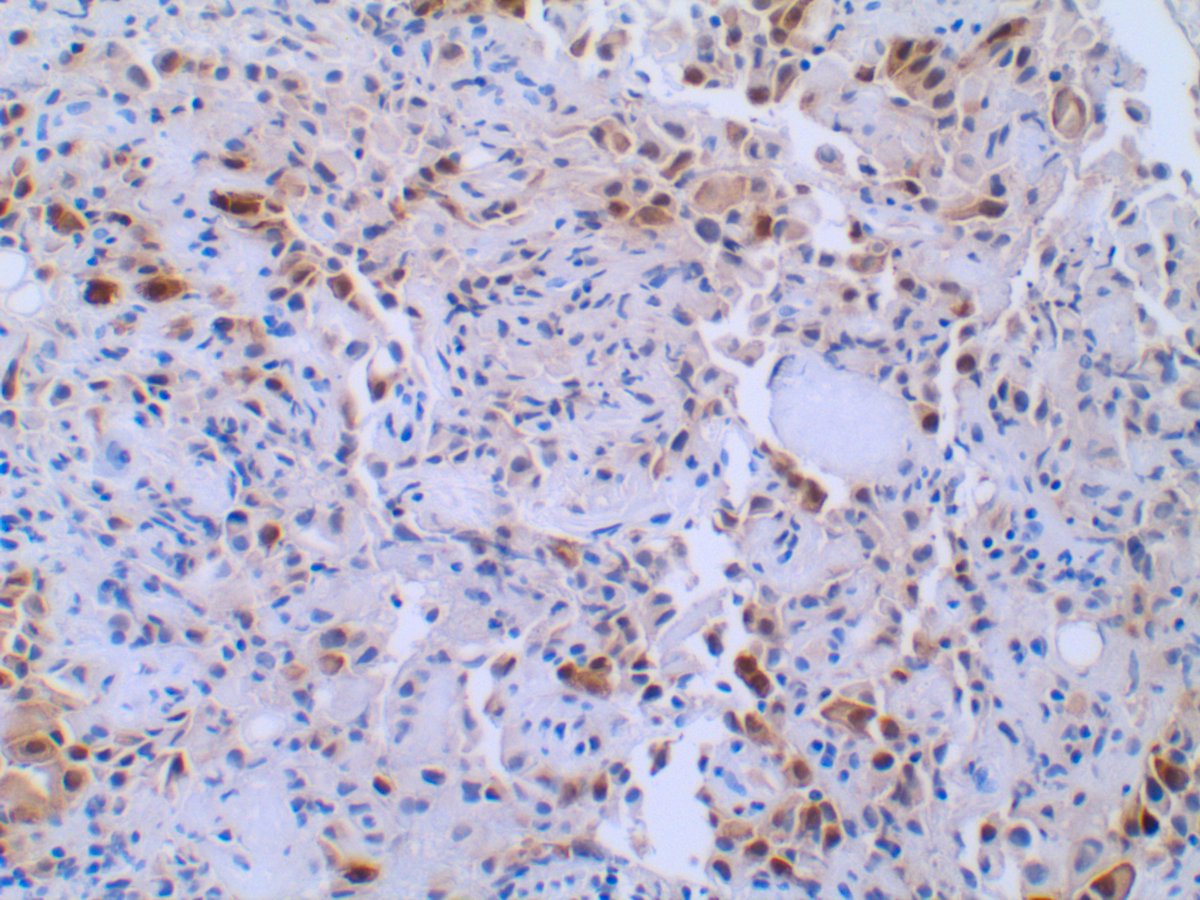 WT1 (left) and Calretinin (right) *should* stain mesothelial cells.