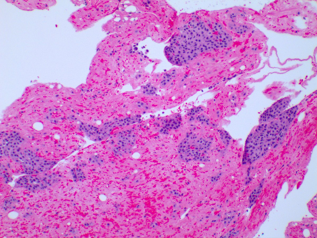 3. And I know this doesn't quite fit the 'pleural lesions' theme, but how about this 64-year-old male presenting with a pulmonary embolus after a heart transplant.