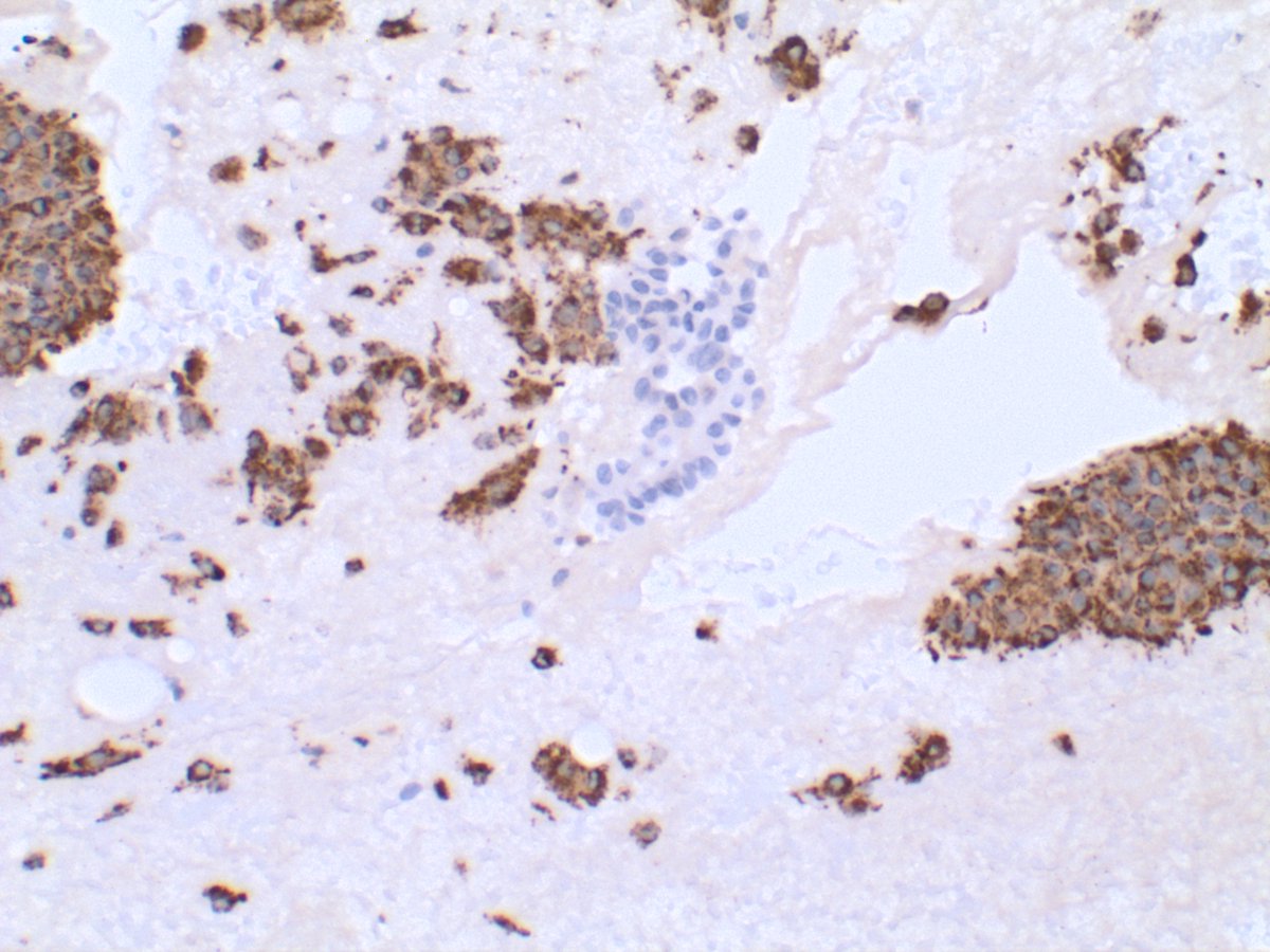 Compare this CD68 stain, which highlights the histiocytes...