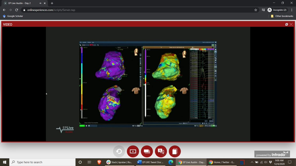 DebbeMcCall's tweet image. #VTach #Ablation 
@aalahmadmd
 #EPLiveAustin