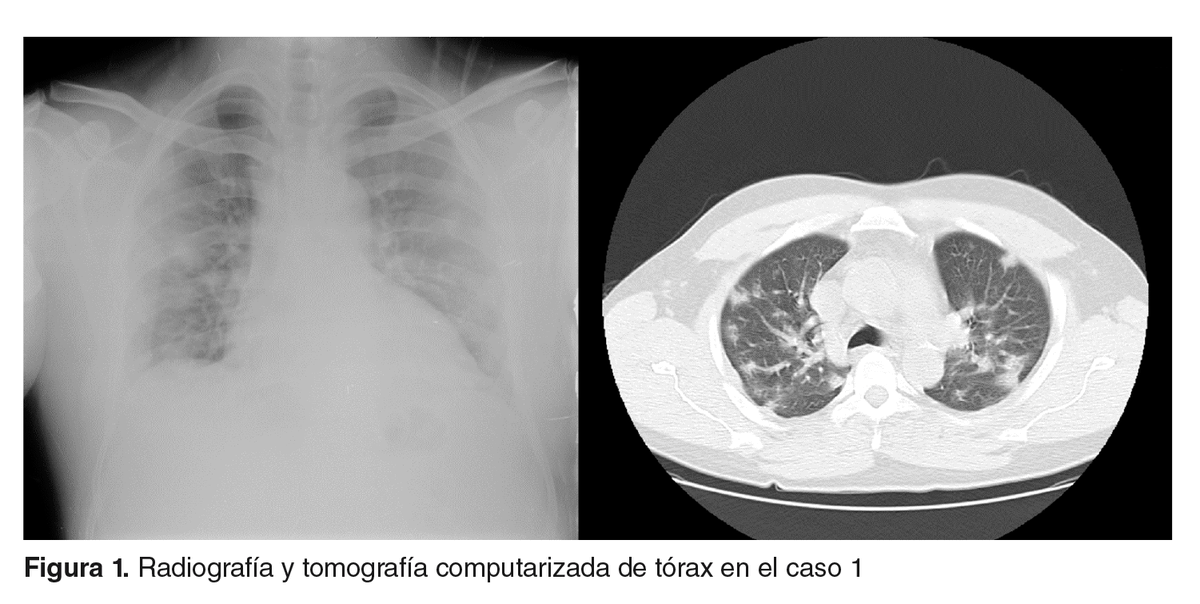 Biomedica_INS's tweet photo. 😷 COVID-19 en pacientes en hemodiálisis en Colombia: reporte de siete casos. https://t.co/YKA3lwpjx2 https://t.co/C3mWkPhW3M