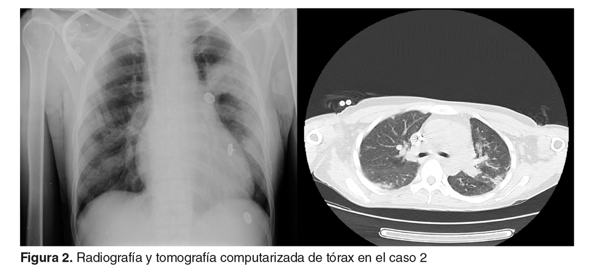 Biomedica_INS's tweet photo. 😷 COVID-19 en pacientes en hemodiálisis en Colombia: reporte de siete casos. https://t.co/YKA3lwpjx2 https://t.co/C3mWkPhW3M
