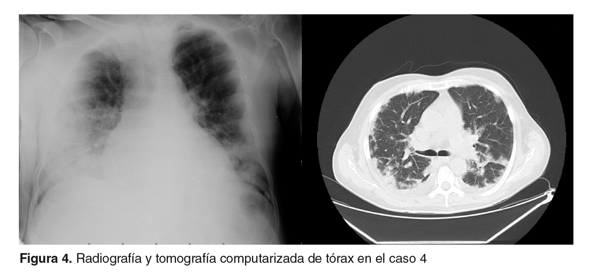 Biomedica_INS's tweet photo. 😷 COVID-19 en pacientes en hemodiálisis en Colombia: reporte de siete casos. https://t.co/YKA3lwpjx2 https://t.co/C3mWkPhW3M