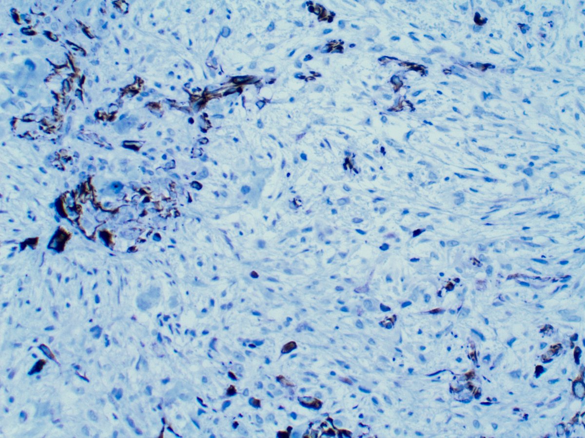This time, we have two components - epithelioid and sarcomatous. Typically, CK5/6 should not stain the sarcomatous portion of the tumor [not done, unfortunately]. WT1 and Calretinin are shown here.
