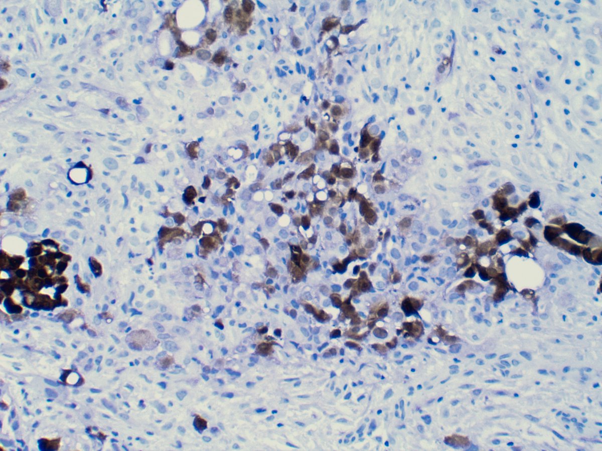 This time, we have two components - epithelioid and sarcomatous. Typically, CK5/6 should not stain the sarcomatous portion of the tumor [not done, unfortunately]. WT1 and Calretinin are shown here.